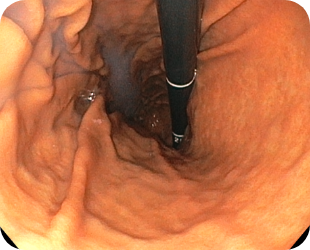 정상위내시경 사진 1