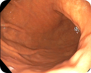 정상위내시경 사진 2