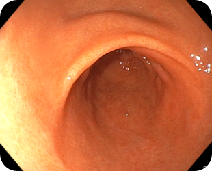 정상위내시경 사진 3
