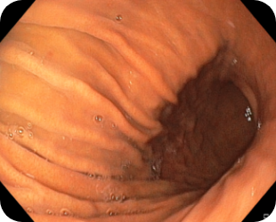 정상위내시경 사진 4