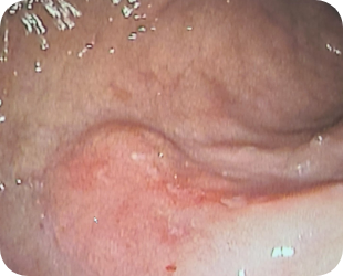 초기 위암 위내시경 사진 1