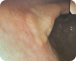 초기 위암 위내시경 사진 2