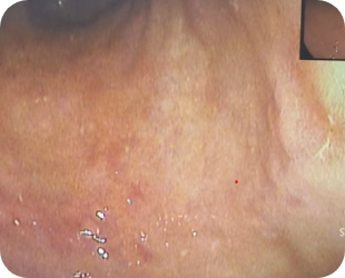 초기 위암 위내시경 사진 3