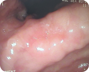초기 위암 위내시경 사진 4
