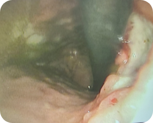 진행성 위암 위내시경 사진 1