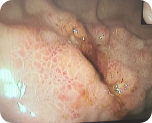 진행성 위암 위내시경 사진 2