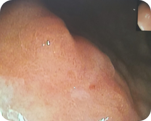 진행성 위암 위내시경 사진 3