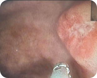 진행성 위암 위내시경 사진 4