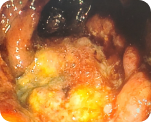 대장암 대장내시경 사진 1