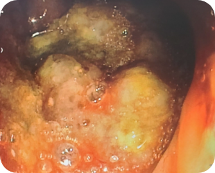 대장암 대장내시경 사진 2