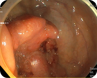 대장암 대장내시경 사진 3