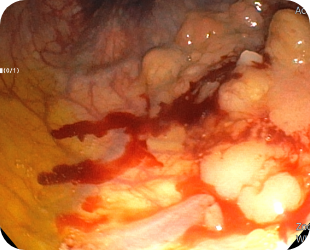 대장암 대장내시경 사진 4